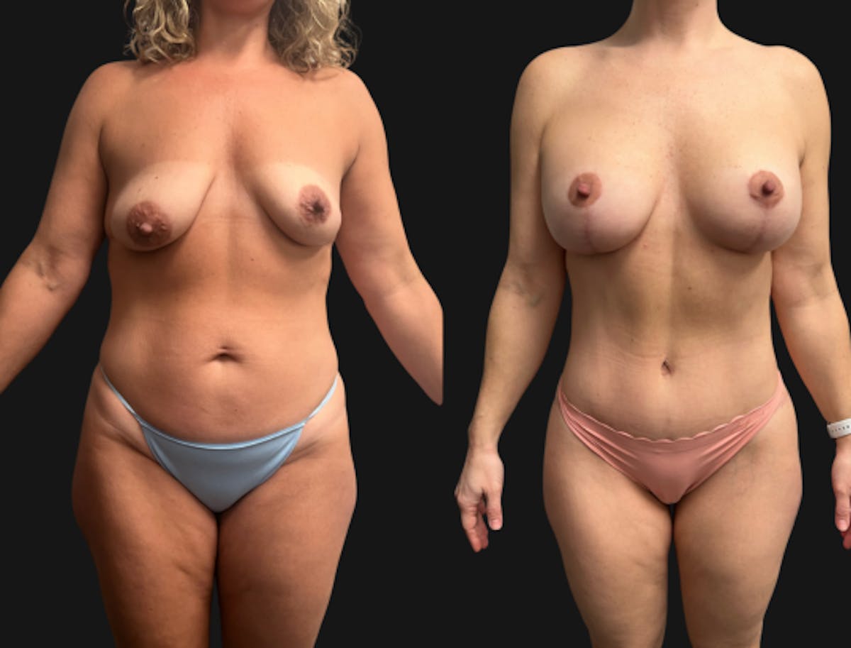 Mommy Makeover Before & After Gallery - Patient 224557 - Image 3