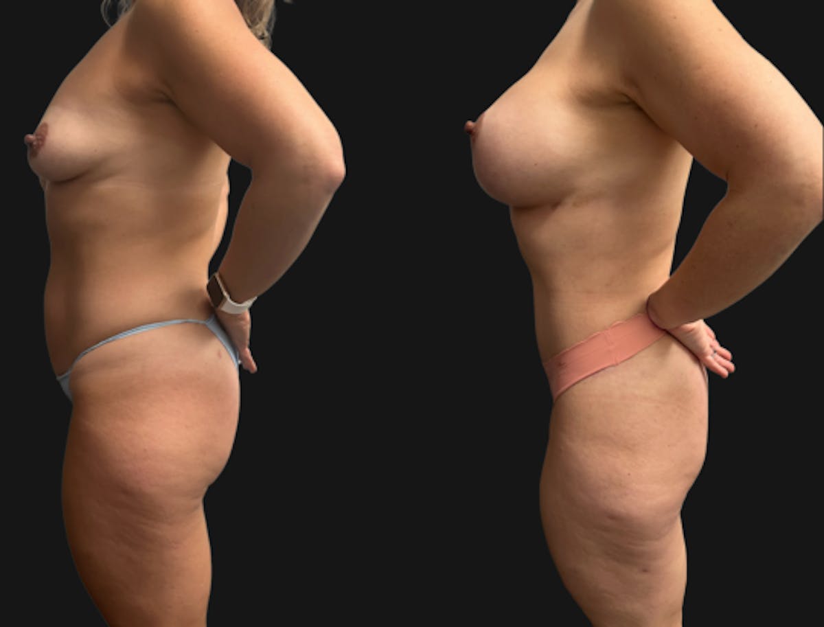 Mommy Makeover Before & After Gallery - Patient 224557 - Image 5