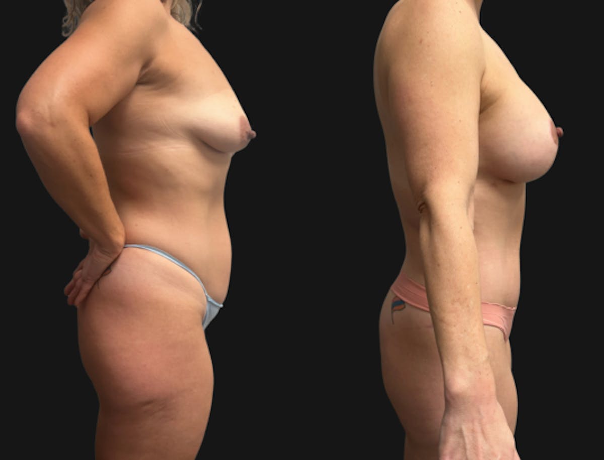 Mommy Makeover Before & After Gallery - Patient 224557 - Image 4