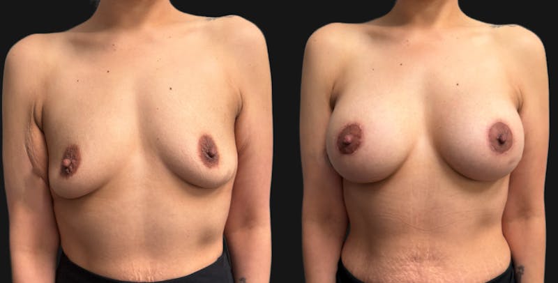 Breast Augmentation with Lift Before & After Gallery - Patient 260350 - Image 1