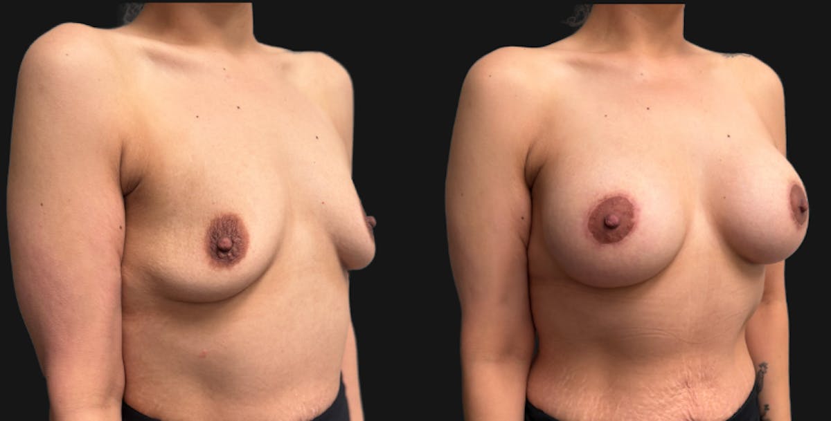 Breast Augmentation with Lift Before & After Gallery - Patient 260350 - Image 2