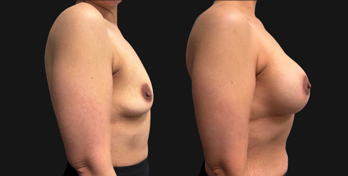 Breast Augmentation with Lift Before & After Gallery - Patient 260350 - Image 5