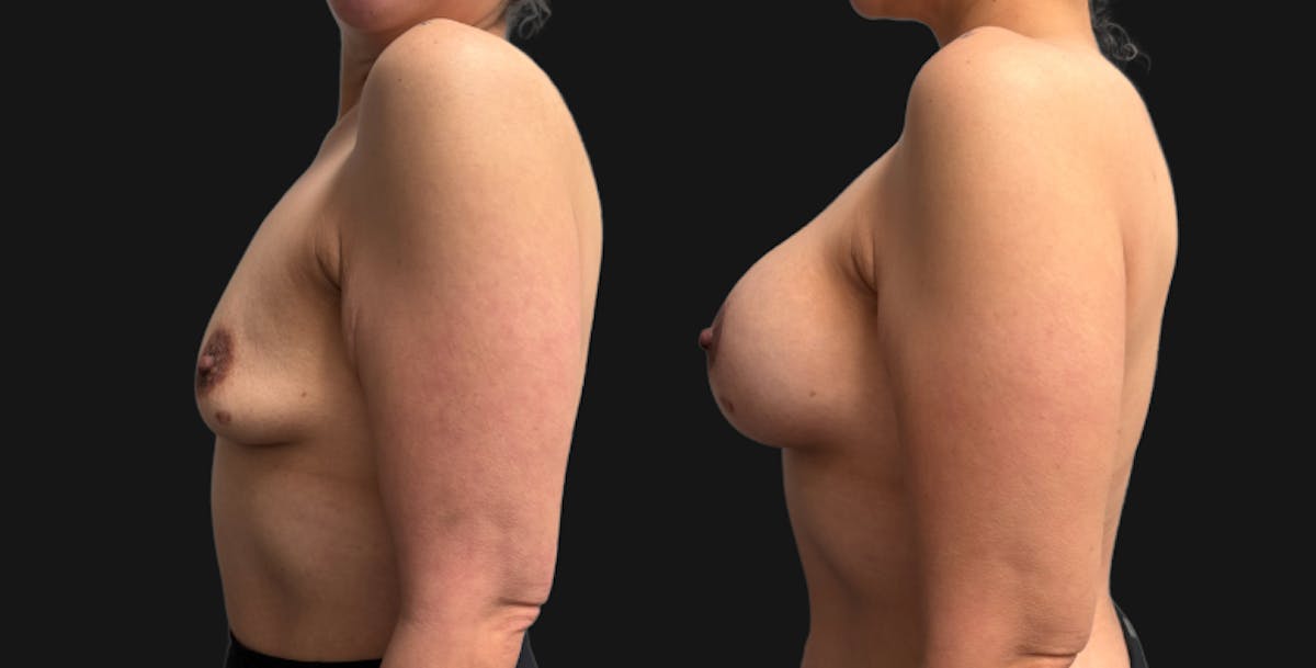 Breast Augmentation with Lift Before & After Gallery - Patient 260350 - Image 4