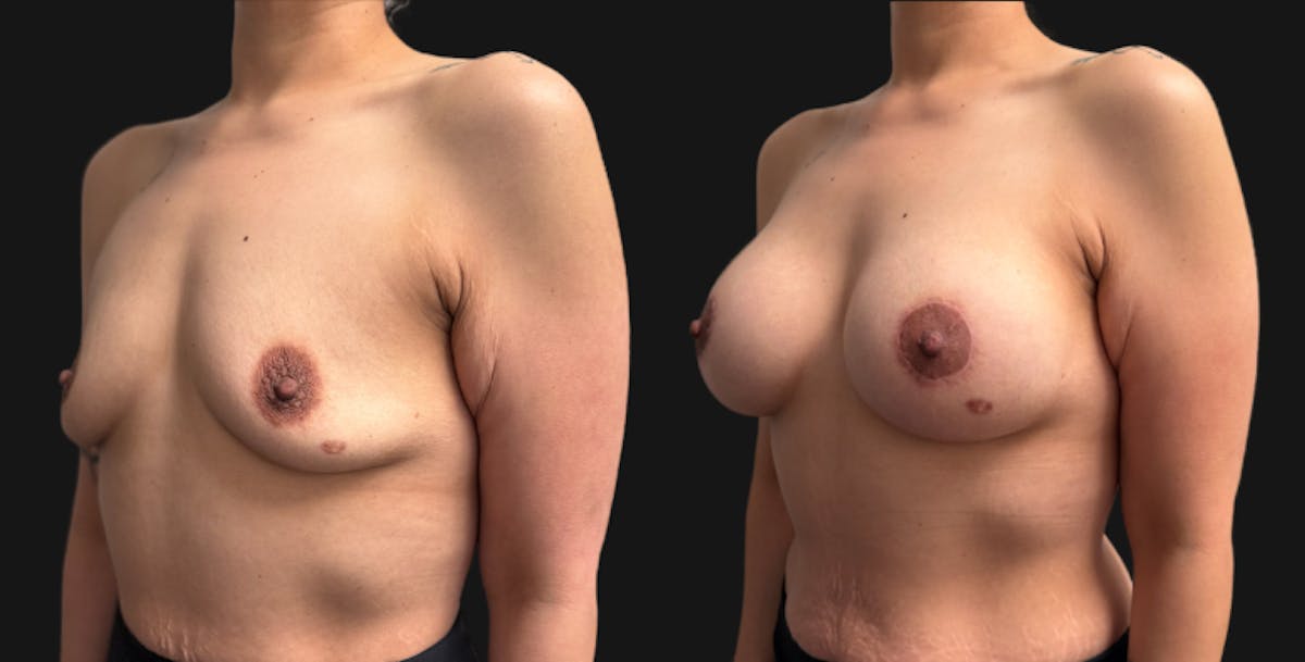 Breast Augmentation with Lift Before & After Gallery - Patient 260350 - Image 3