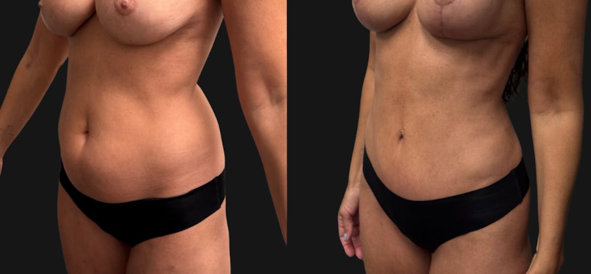 Hybrid Abdominoplasty Before & After Gallery - Patient 578160 - Image 2