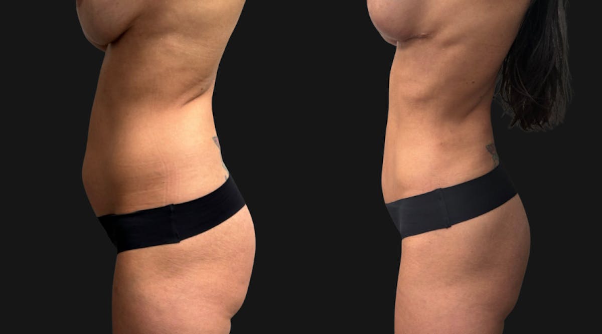 Hybrid Abdominoplasty Before & After Gallery - Patient 578160 - Image 4
