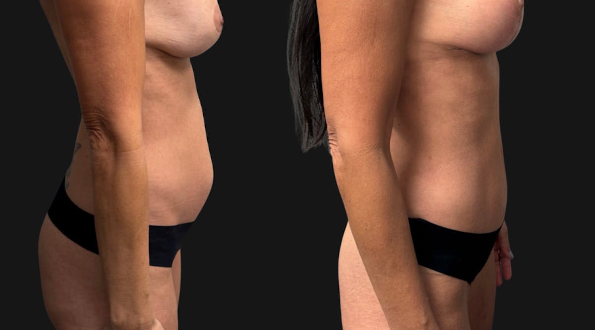 Hybrid Abdominoplasty Before & After Gallery - Patient 578160 - Image 5