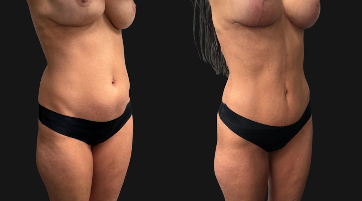 Hybrid Abdominoplasty Before & After Gallery - Patient 578160 - Image 6