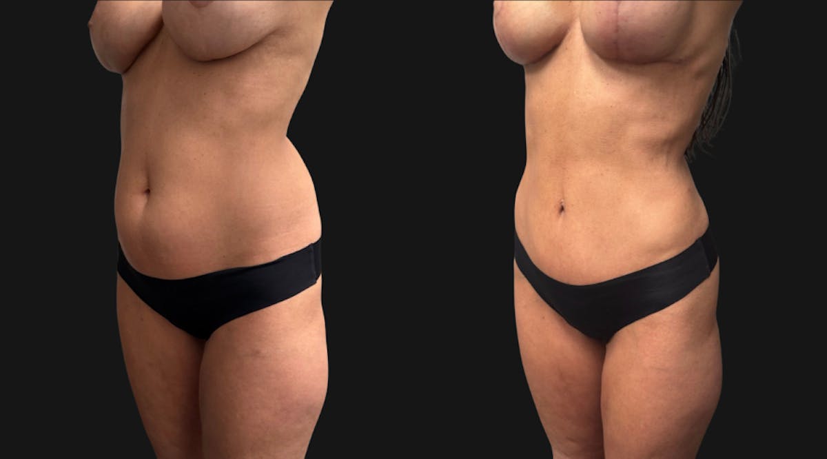 Hybrid Abdominoplasty Before & After Gallery - Patient 578160 - Image 3