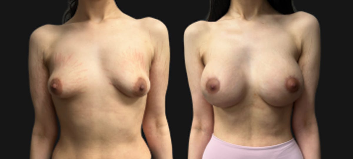 Tuberous Breast Before & After Gallery - Patient 312822 - Image 1