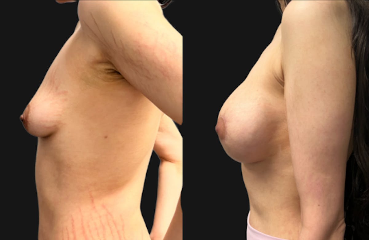 Tuberous Breast Before & After Gallery - Patient 312822 - Image 5