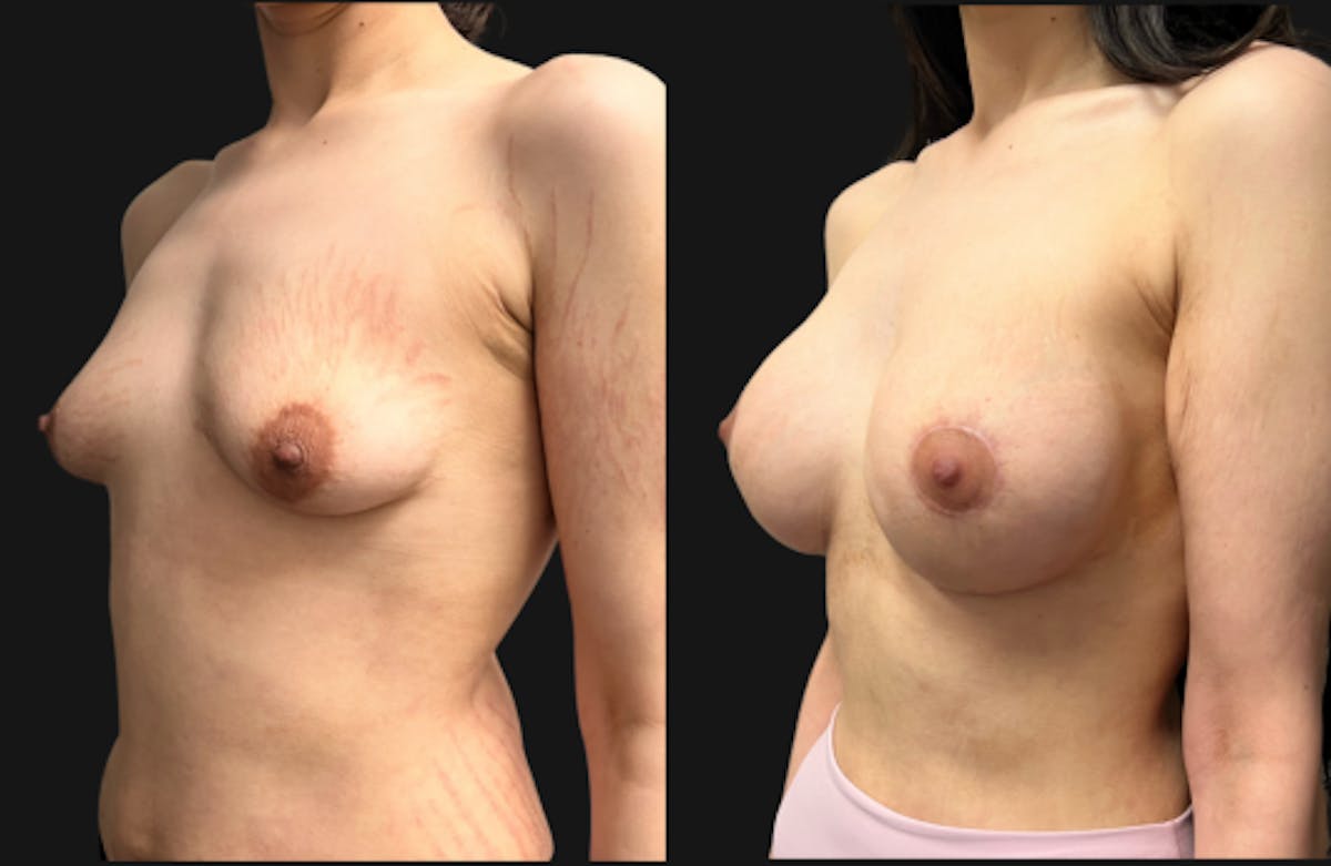 Tuberous Breast Before & After Gallery - Patient 312822 - Image 4