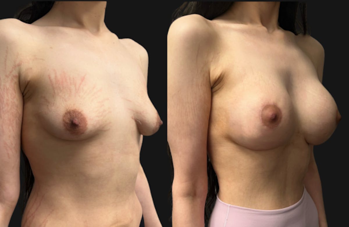 Tuberous Breast Before & After Gallery - Patient 312822 - Image 2