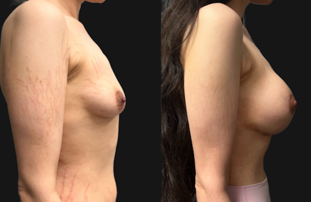 Tuberous Breast Before & After Gallery - Patient 312822 - Image 3