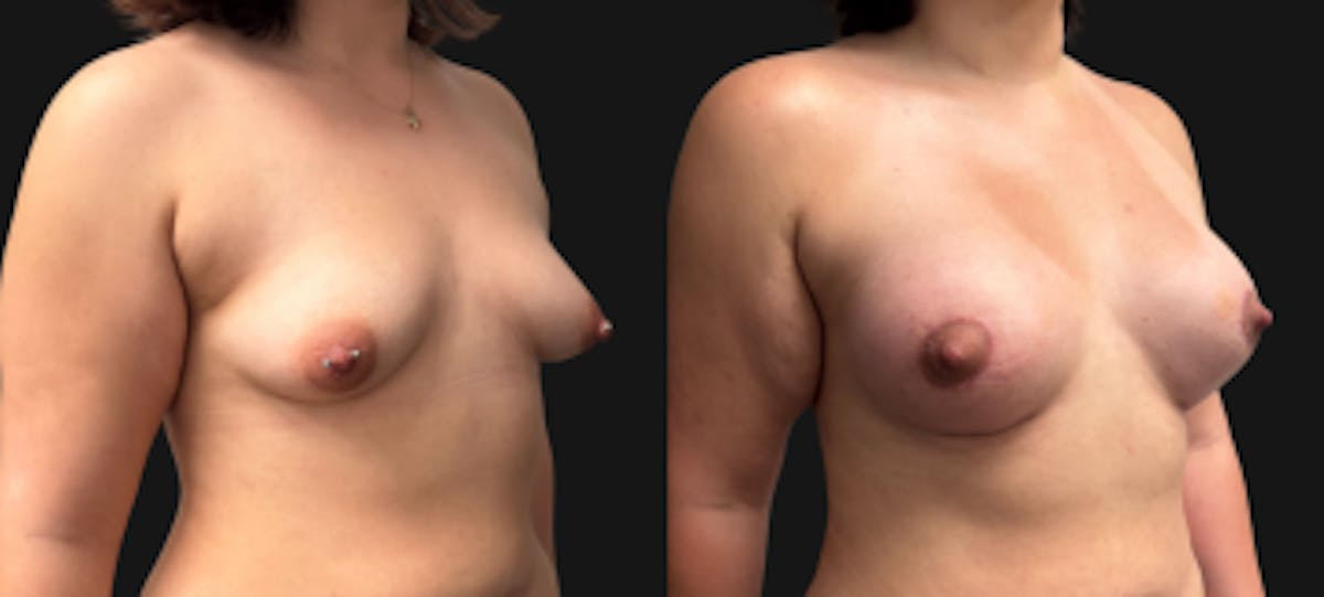 Tuberous Breast Before & After Gallery - Patient 280049 - Image 2