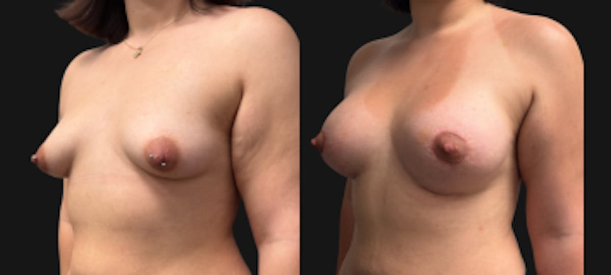 Tuberous Breast Before & After Gallery - Patient 280049 - Image 4