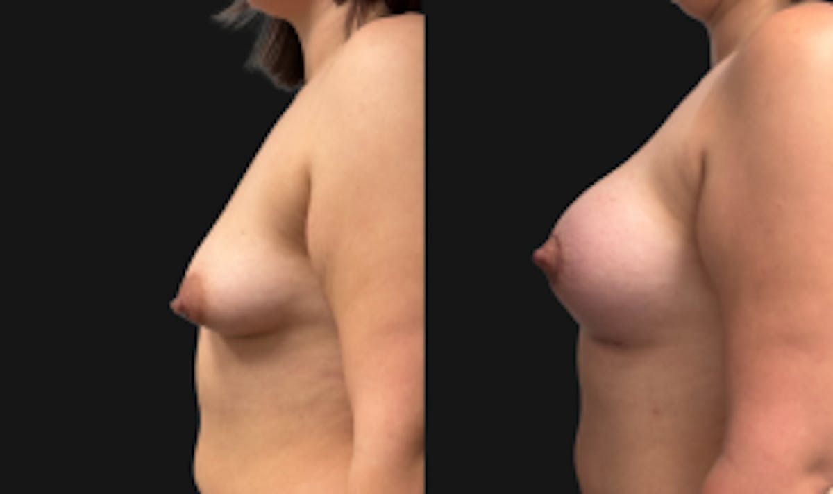 Tuberous Breast Before & After Gallery - Patient 280049 - Image 5