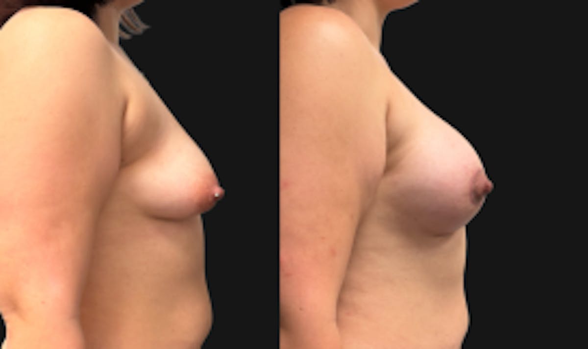 Tuberous Breast Before & After Gallery - Patient 280049 - Image 3