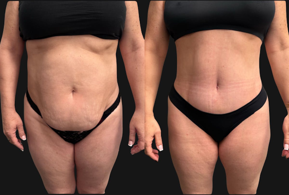 Tummy Tuck Before & After Gallery - Patient 228634 - Image 2