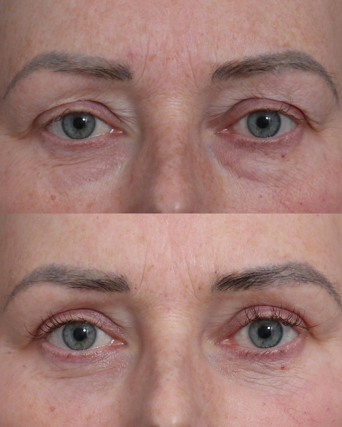 Blepharoplasty Before & After Gallery - Patient 205505 - Image 1