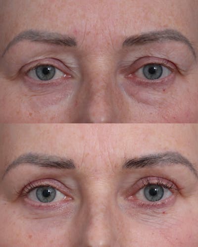 Blepharoplasty Before & After Gallery - Patient 205505 - Image 1