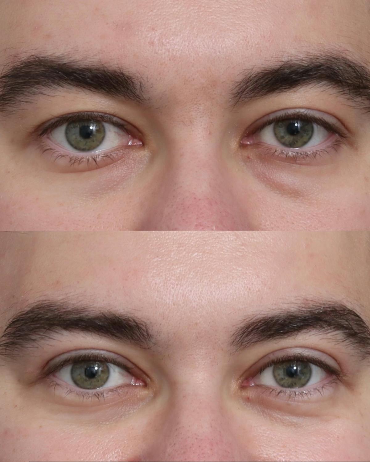 Blepharoplasty Before & After Gallery - Patient 210839 - Image 1