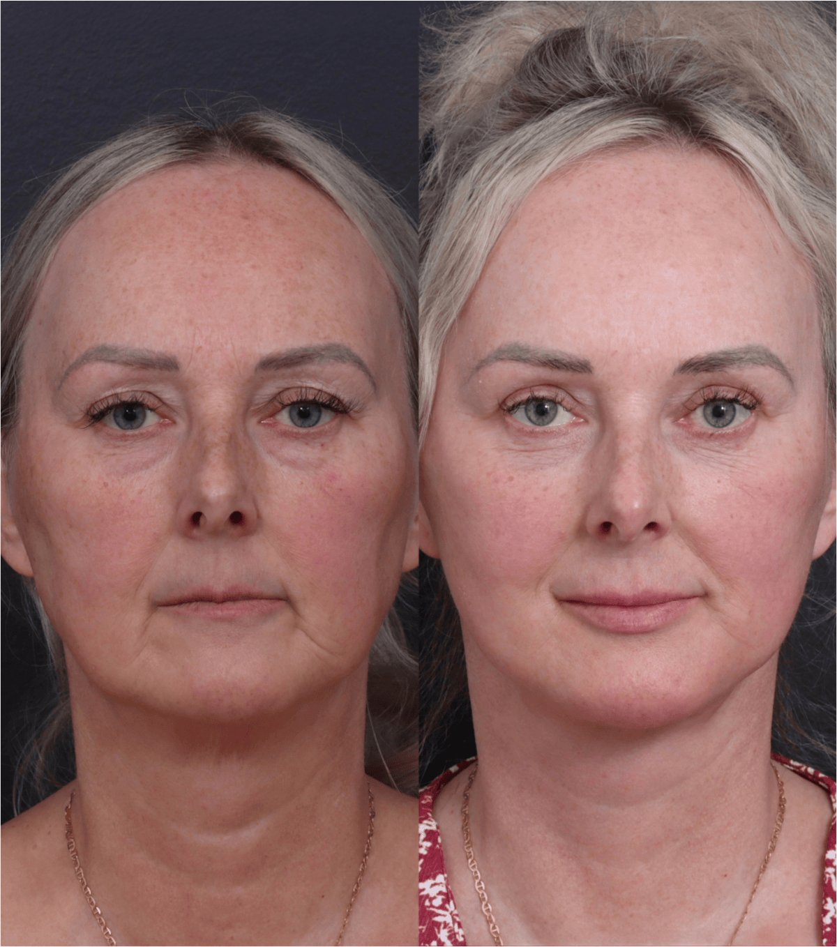 Facelift Before & After Gallery - Patient 229419 - Image 1