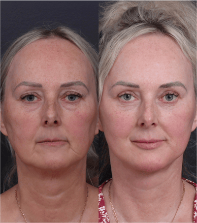 Facelift Before & After Gallery - Patient 229419 - Image 1