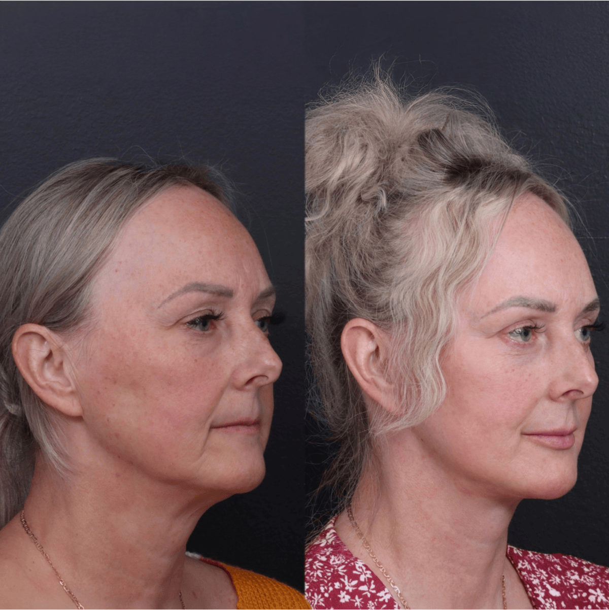 Facelift Before & After Gallery - Patient 229419 - Image 2