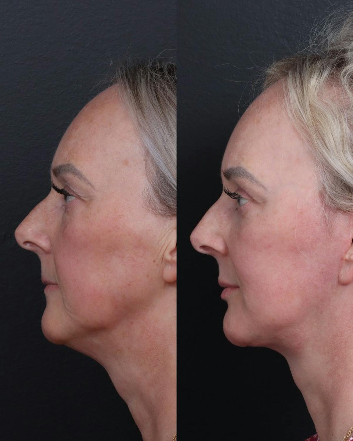 Facelift Before & After Gallery - Patient 229419 - Image 3