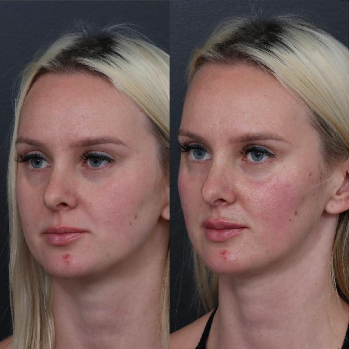 Dermal Filler Before & After Gallery - Patient 424732 - Image 1