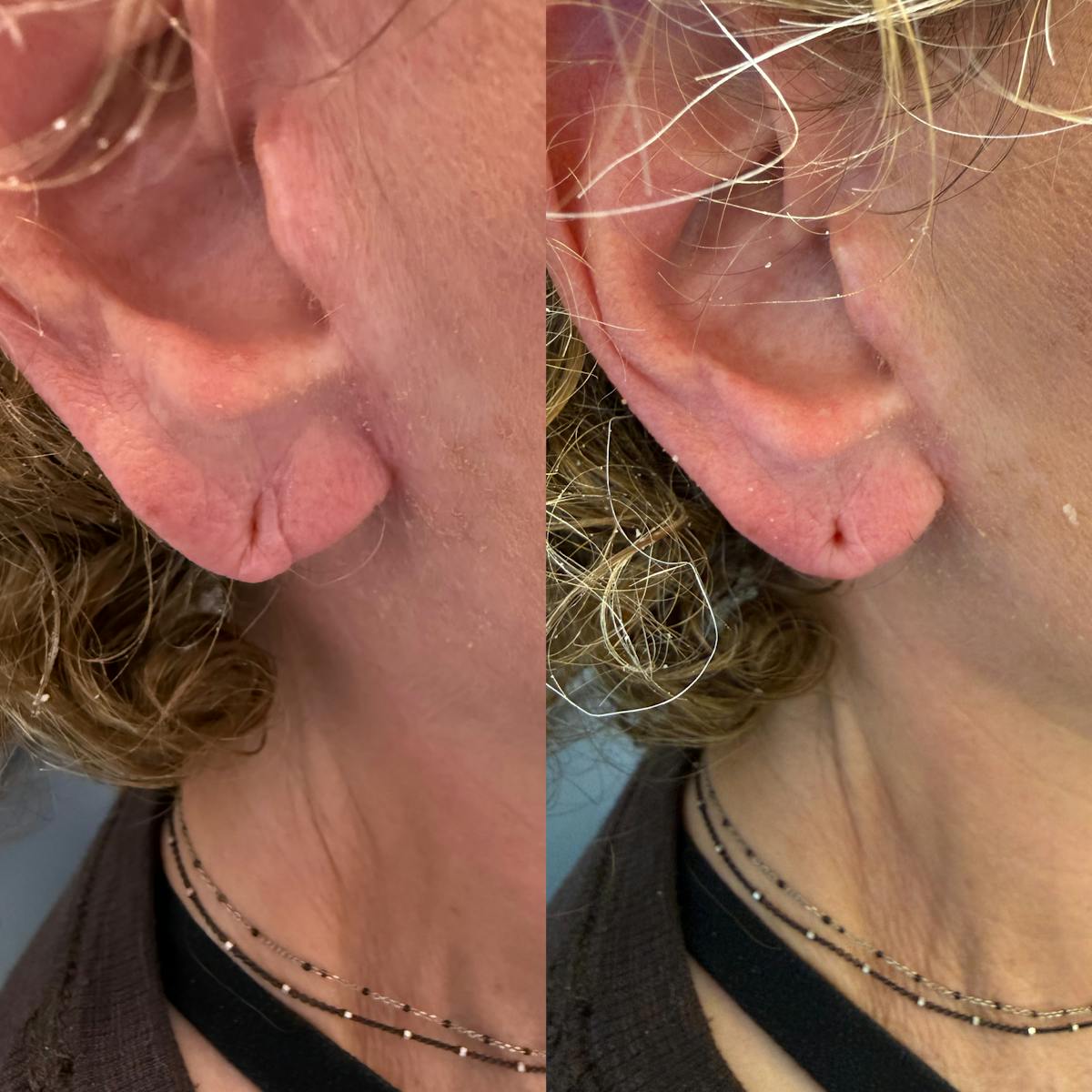 Dermal Filler Before & After Gallery - Patient 225710 - Image 1