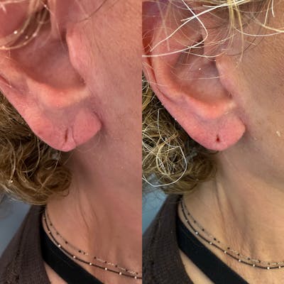 Dermal Filler Before & After Gallery - Patient 225710 - Image 1