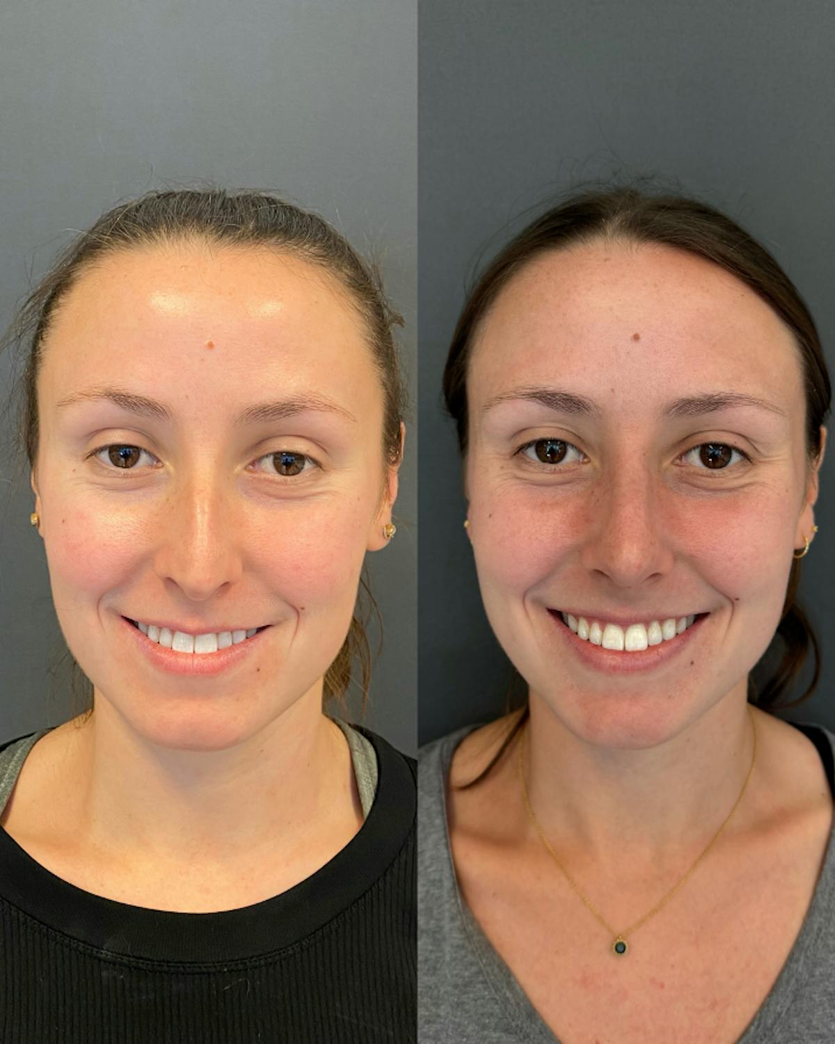 Rhinoplasty Before & After Gallery - Patient 245668 - Image 1