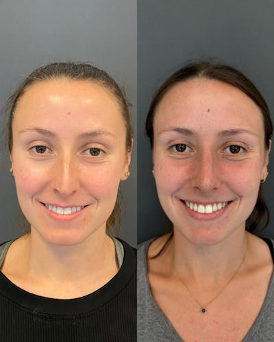 Rhinoplasty Before & After Gallery - Patient 245668 - Image 1
