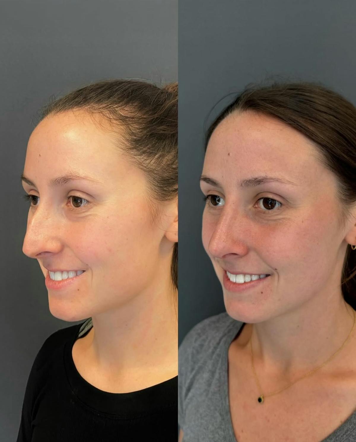 Rhinoplasty Before & After Gallery - Patient 245668 - Image 2