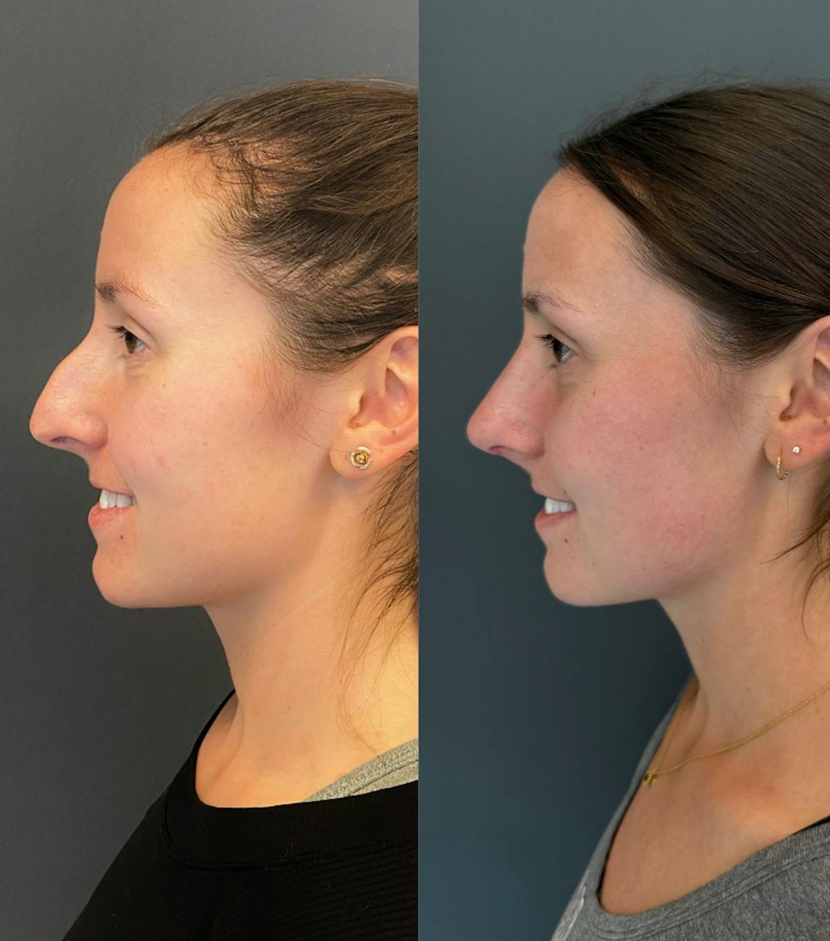 Rhinoplasty Before & After Gallery - Patient 245668 - Image 3