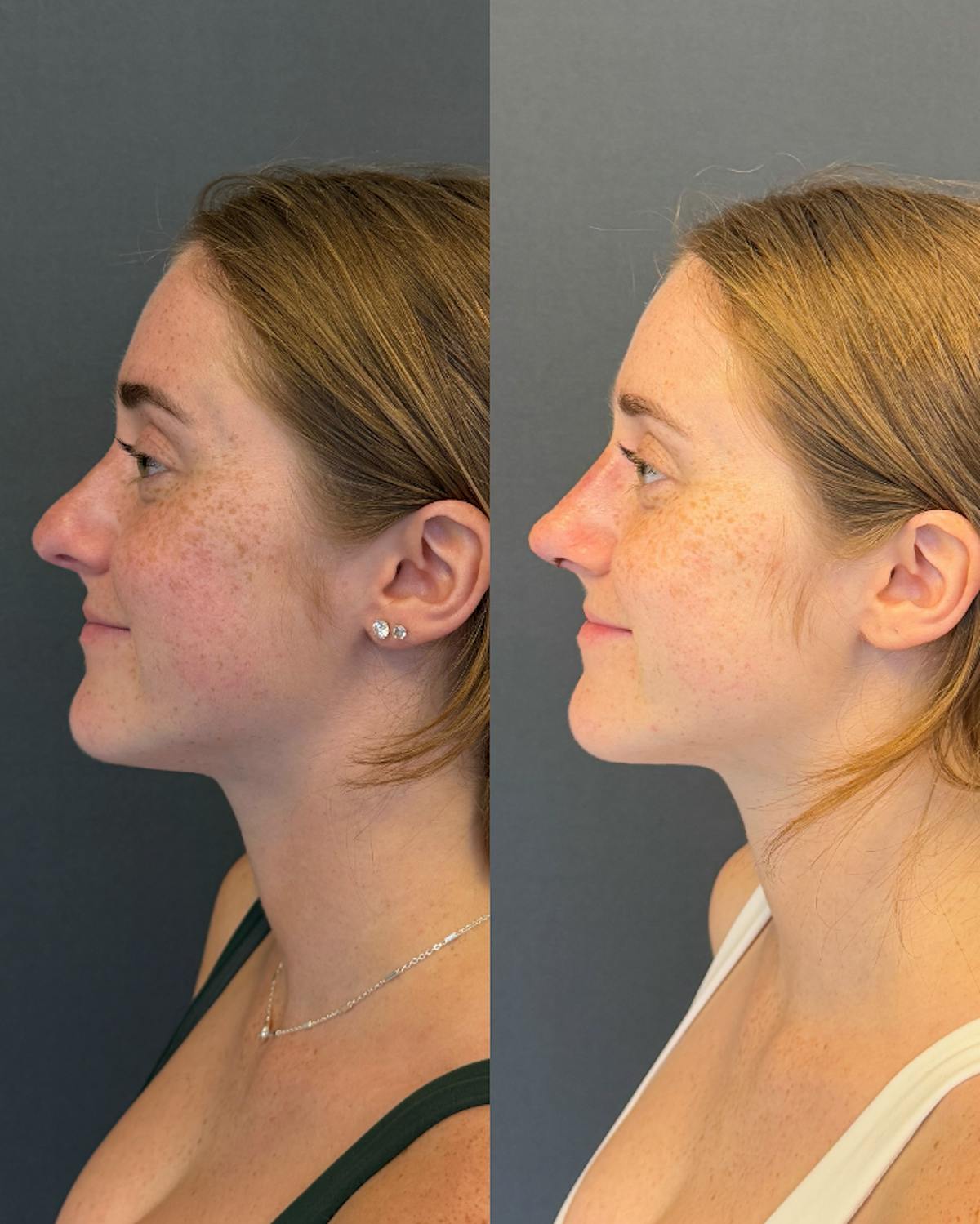 Rhinoplasty Before & After Gallery - Patient 423317 - Image 1