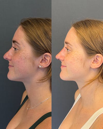 Revision Rhinoplasty Before & After Gallery - Patient 125072 - Image 1