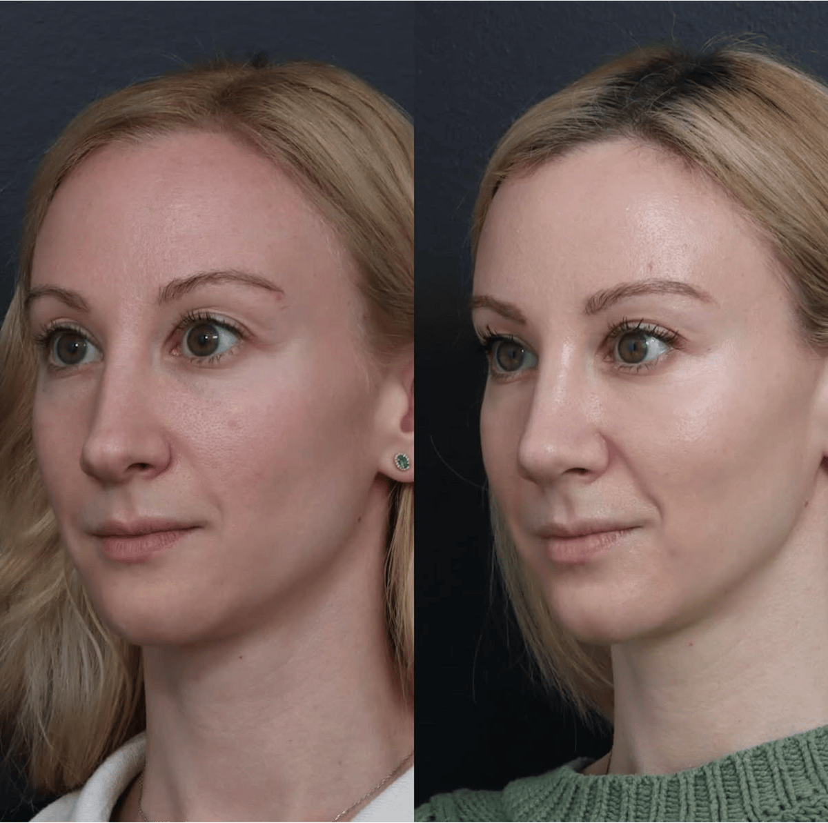 Revision Rhinoplasty Before & After Gallery - Patient 277382 - Image 1