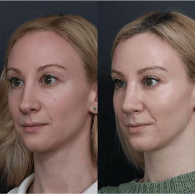 Revision Rhinoplasty Before & After Gallery - Patient 277382 - Image 1