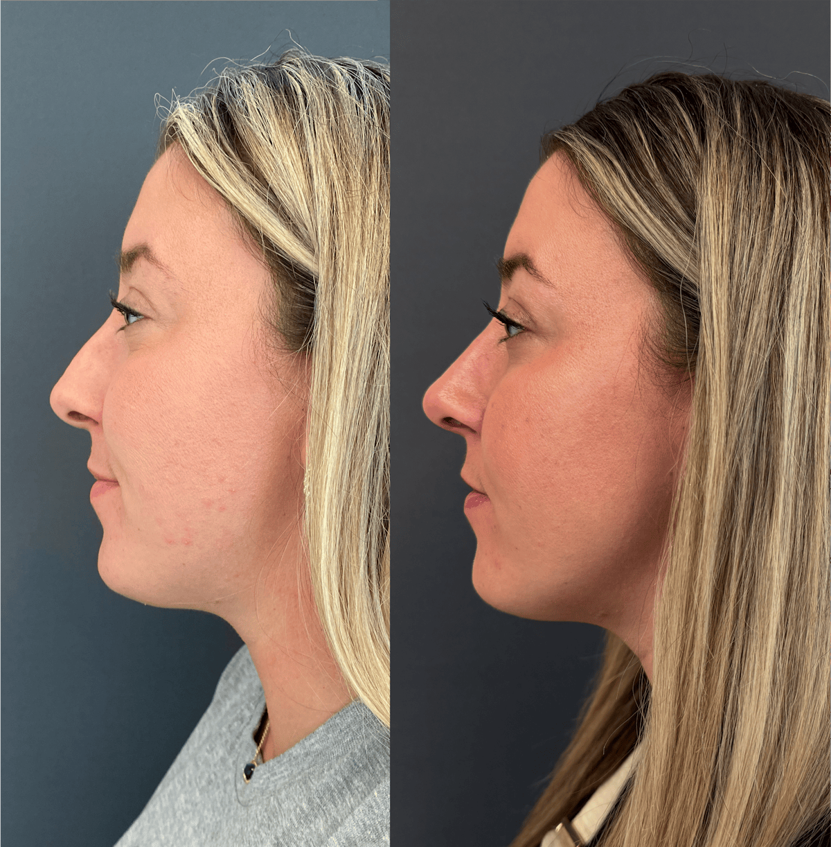 Functional Nasal Surgery Before & After Gallery - Patient 400867 - Image 1