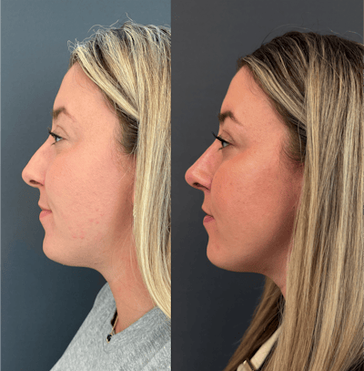 Functional Nasal Surgery Before & After Gallery - Patient 400867 - Image 1
