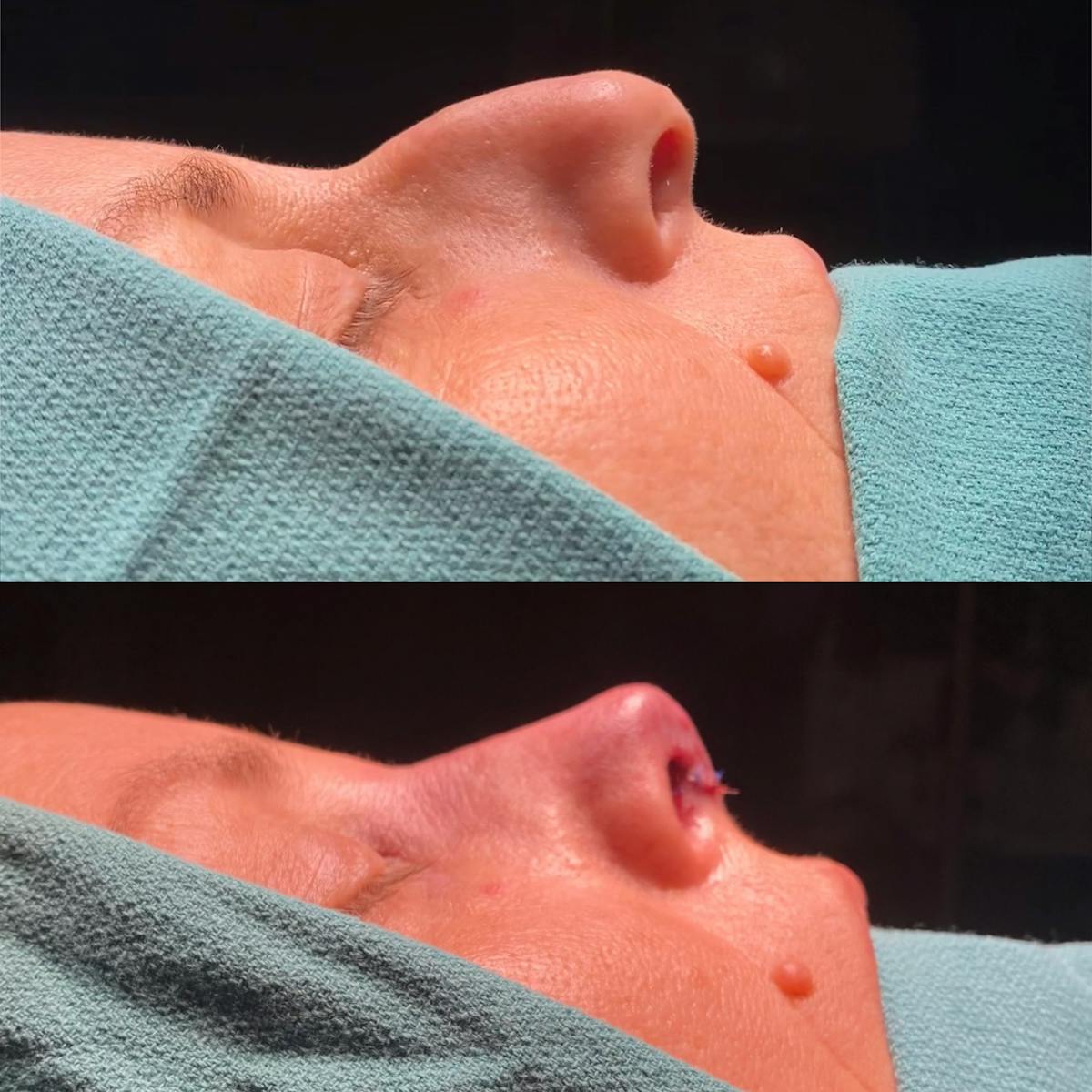 Functional Nasal Surgery Before & After Gallery - Patient 286380 - Image 1