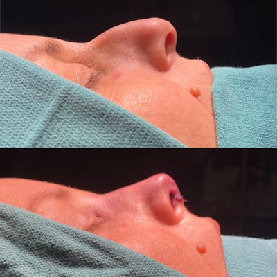Functional Nasal Surgery Before & After Gallery - Patient 286380 - Image 1