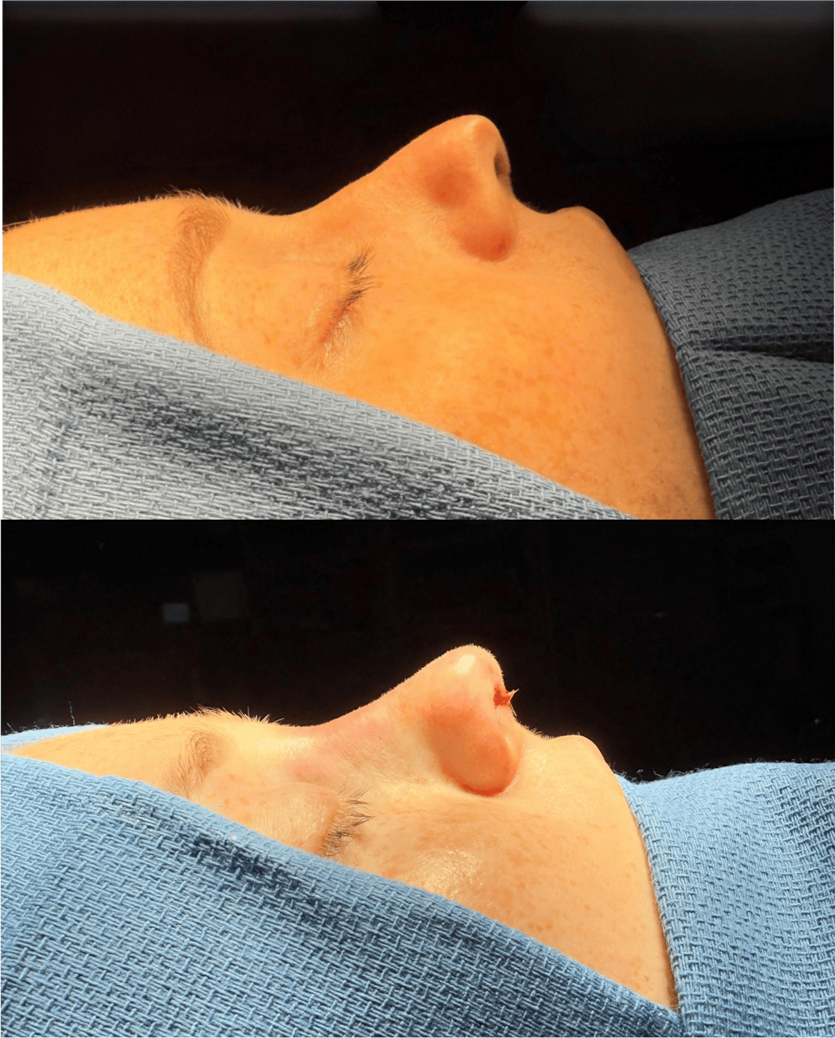 Rhinoplasty Before & After Gallery - Patient 273608 - Image 1