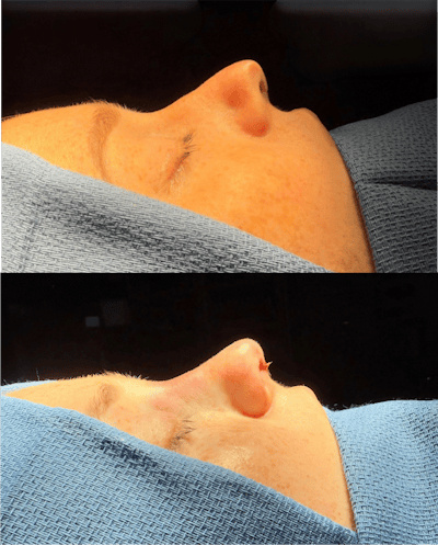 Revision Rhinoplasty Before & After Gallery - Patient 358597 - Image 1