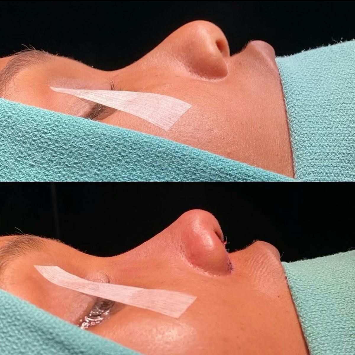 Rhinoplasty Before & After Gallery - Patient 331177 - Image 1