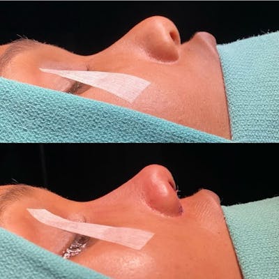 Rhinoplasty Before & After Gallery - Patient 331177 - Image 1