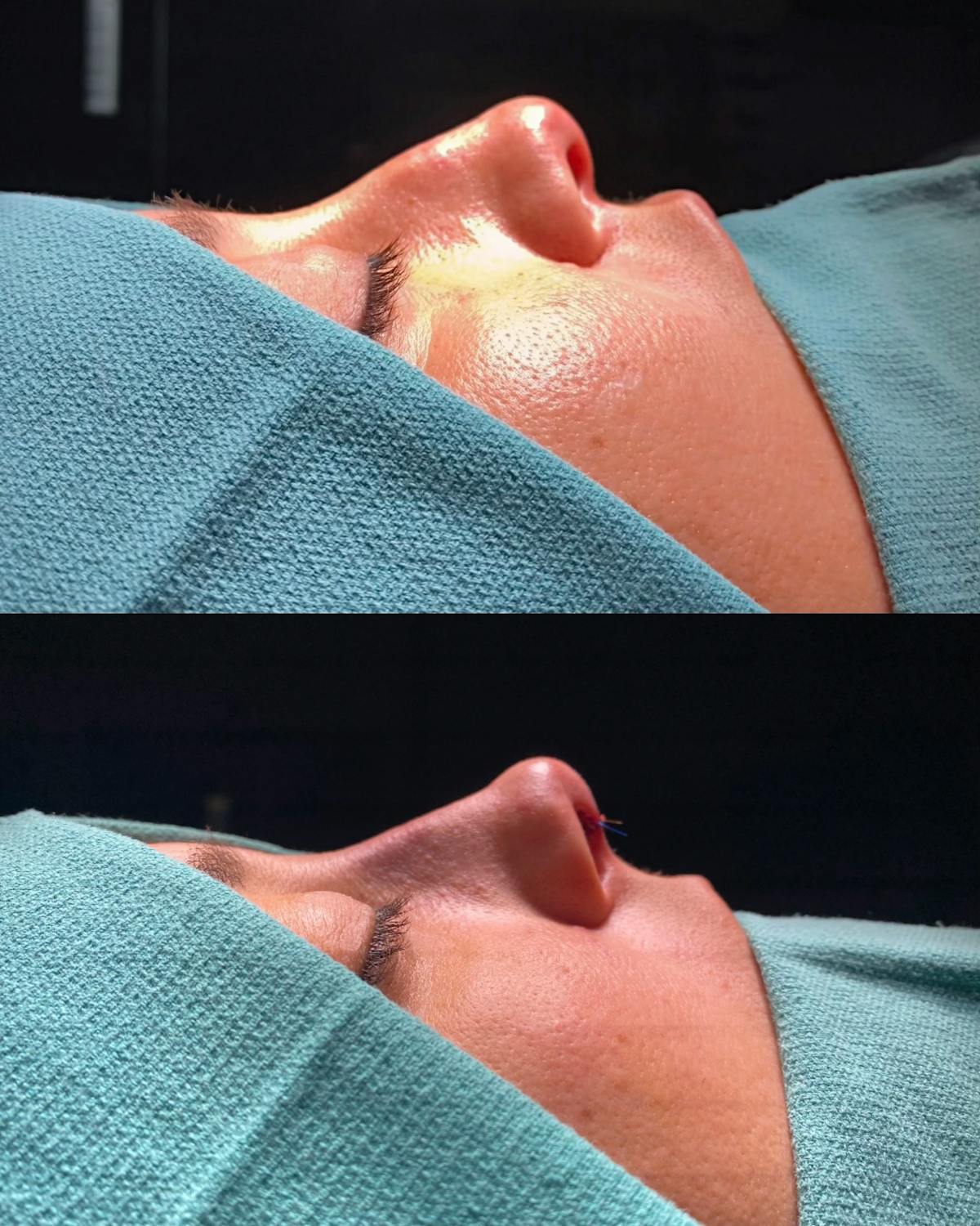 Functional Nasal Surgery Before & After Gallery - Patient 194670 - Image 1